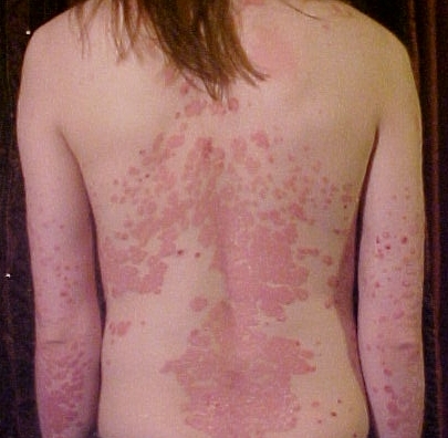 Psoriasis, Psoriatic Arthritis and Gout
